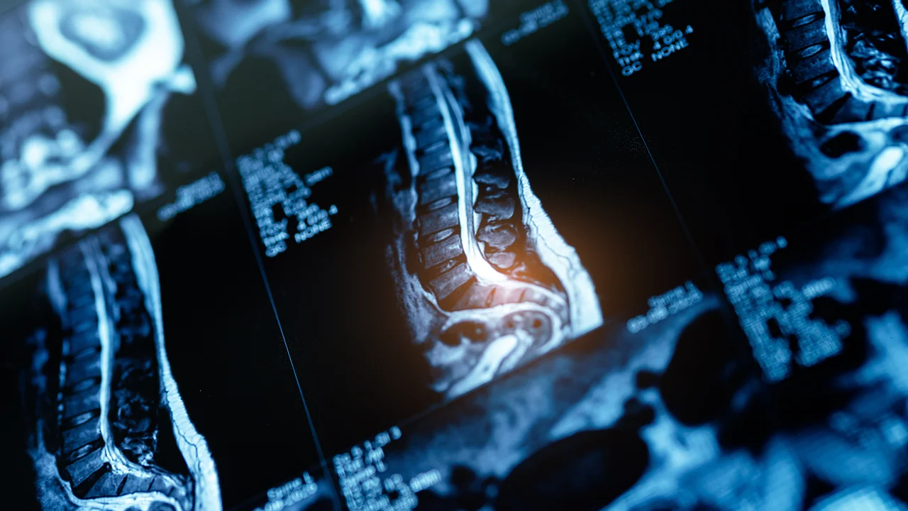 Medical MRI scan of a human spine with a bright glow highlighting a lower back disc issue.