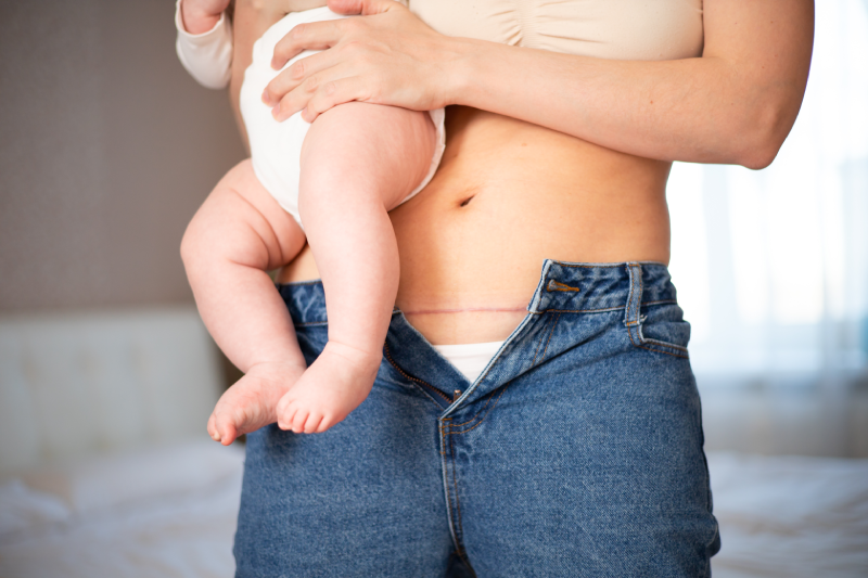 Mom's abdomen after cesarean section. Scar seam. A young mother holds the baby in her arms. Real motherhood.